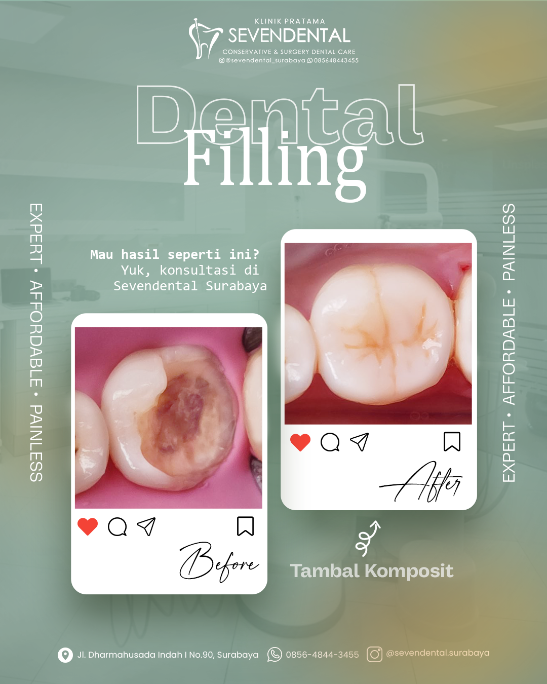 Feed BA Dental Filling