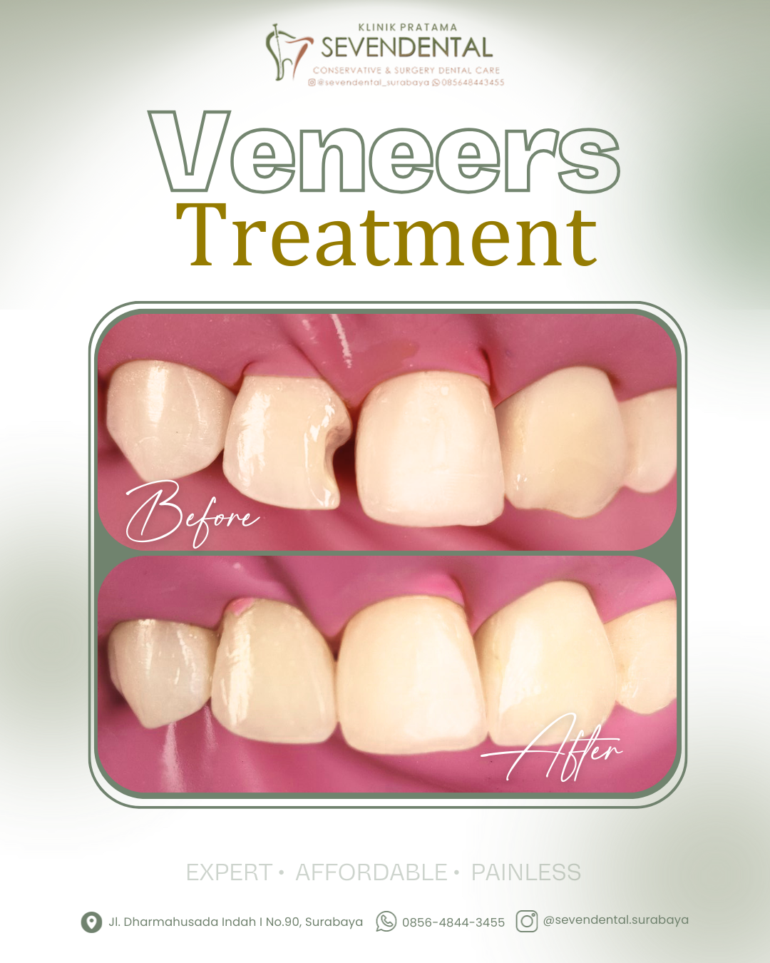 Feed BA Veneers Treatment