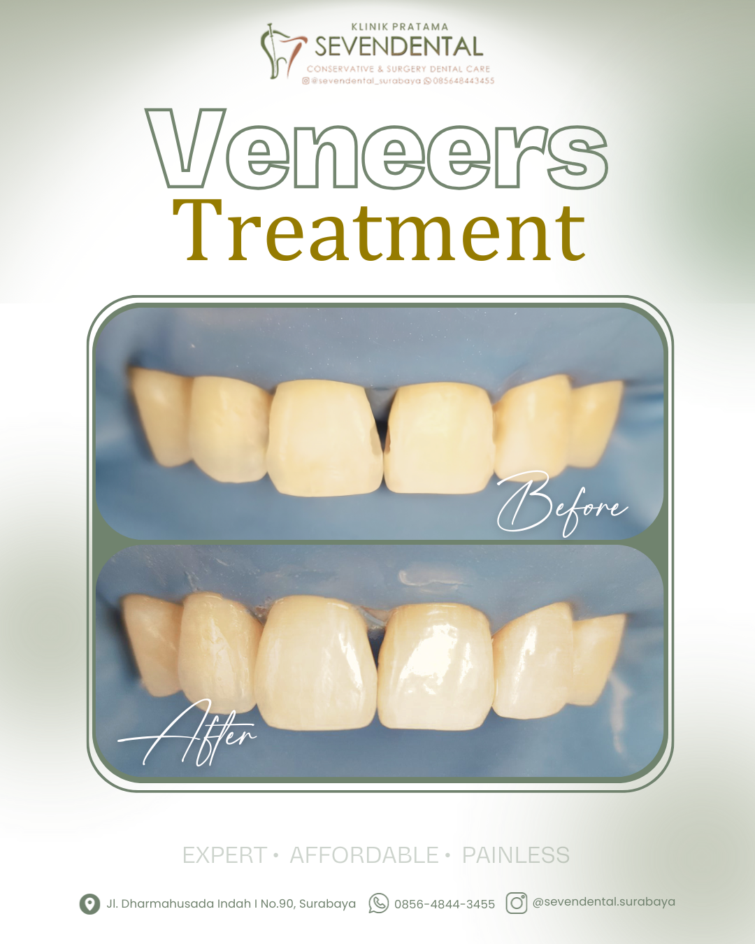 Feed BA veneer wirawidita