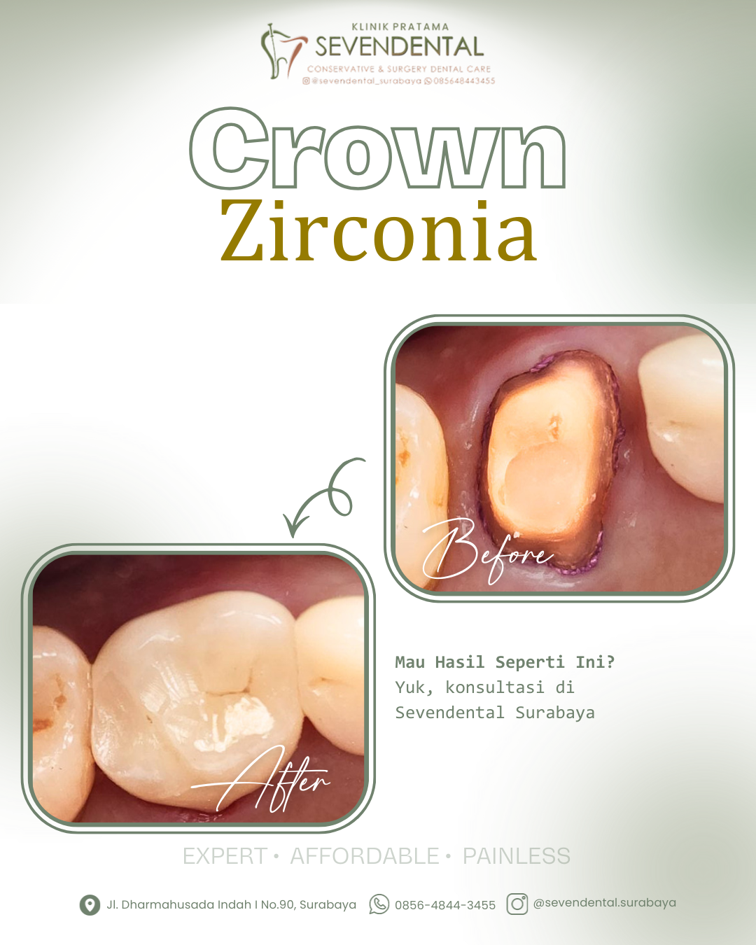 Feed Crown Zirconia