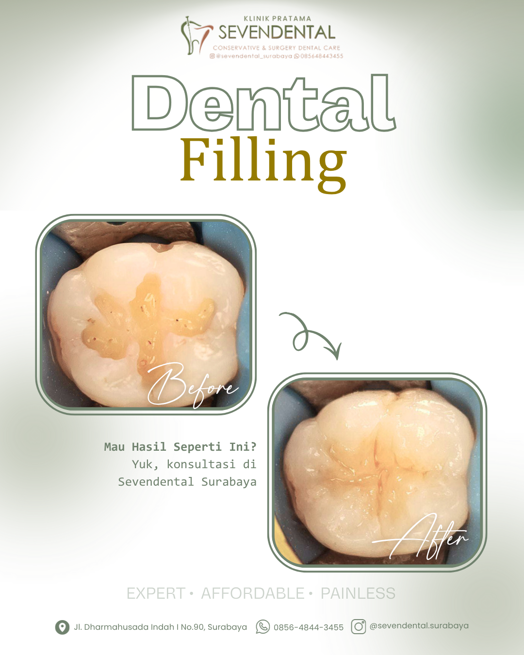 Feed Dental Filling