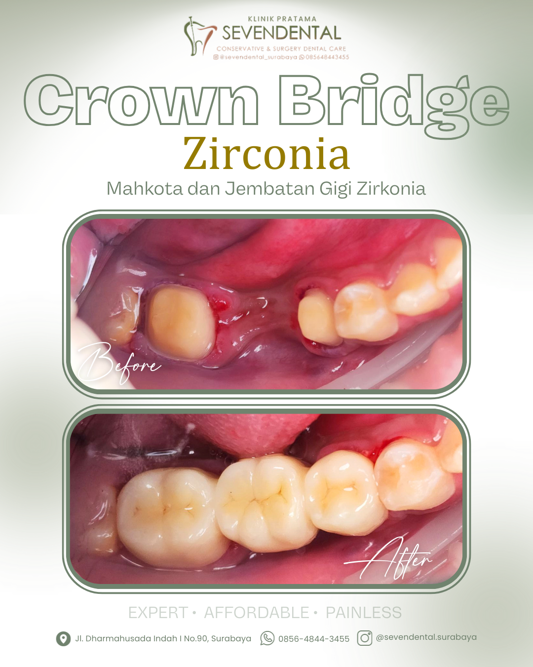 Feed ba crown bridge athar devano