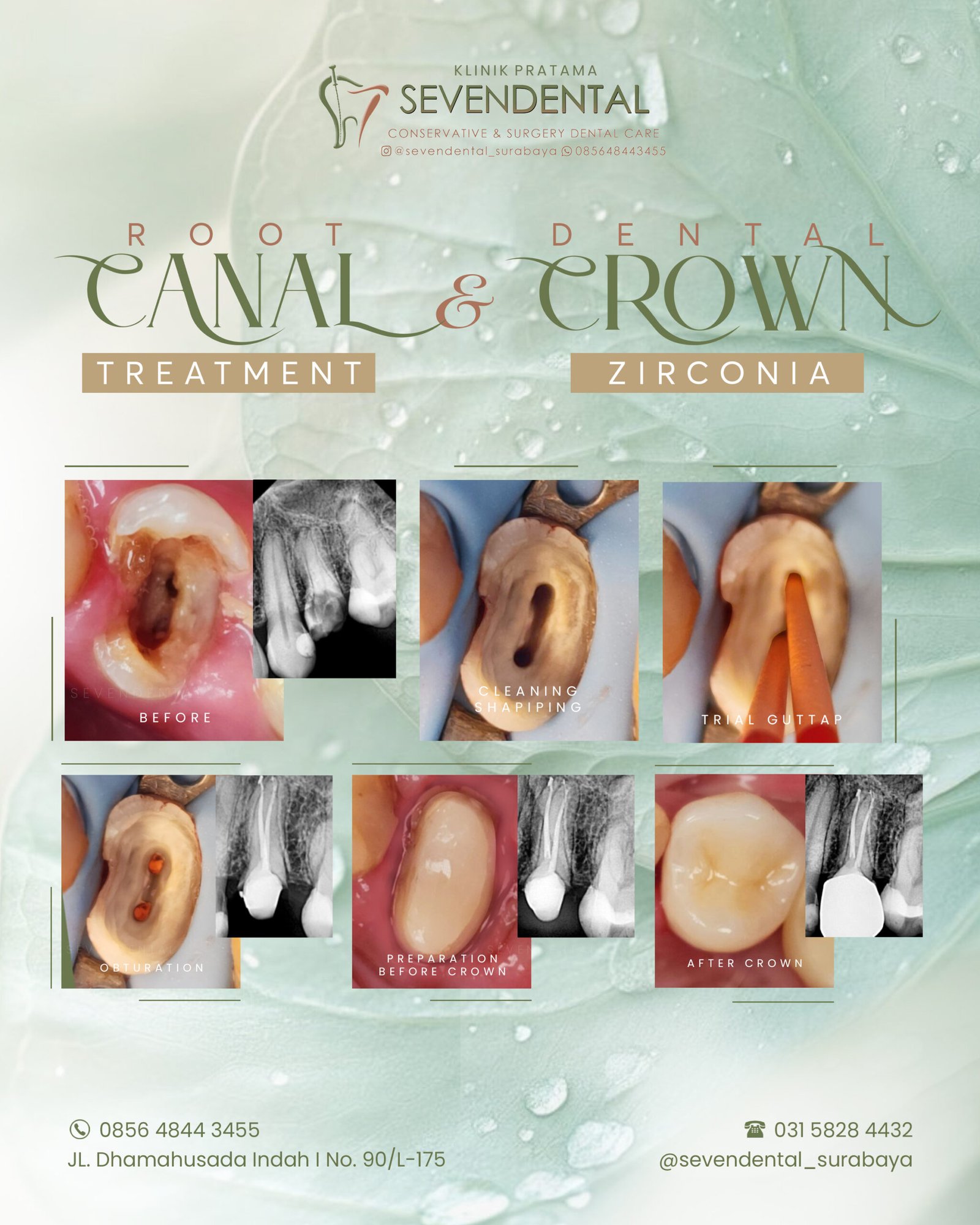 BA CANAL ROOT CROWN FEED IG JUMAT