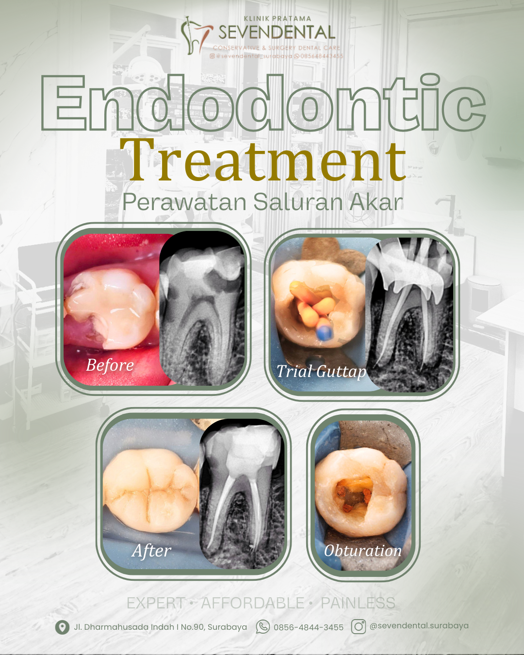Feed BA Endodontic Twien