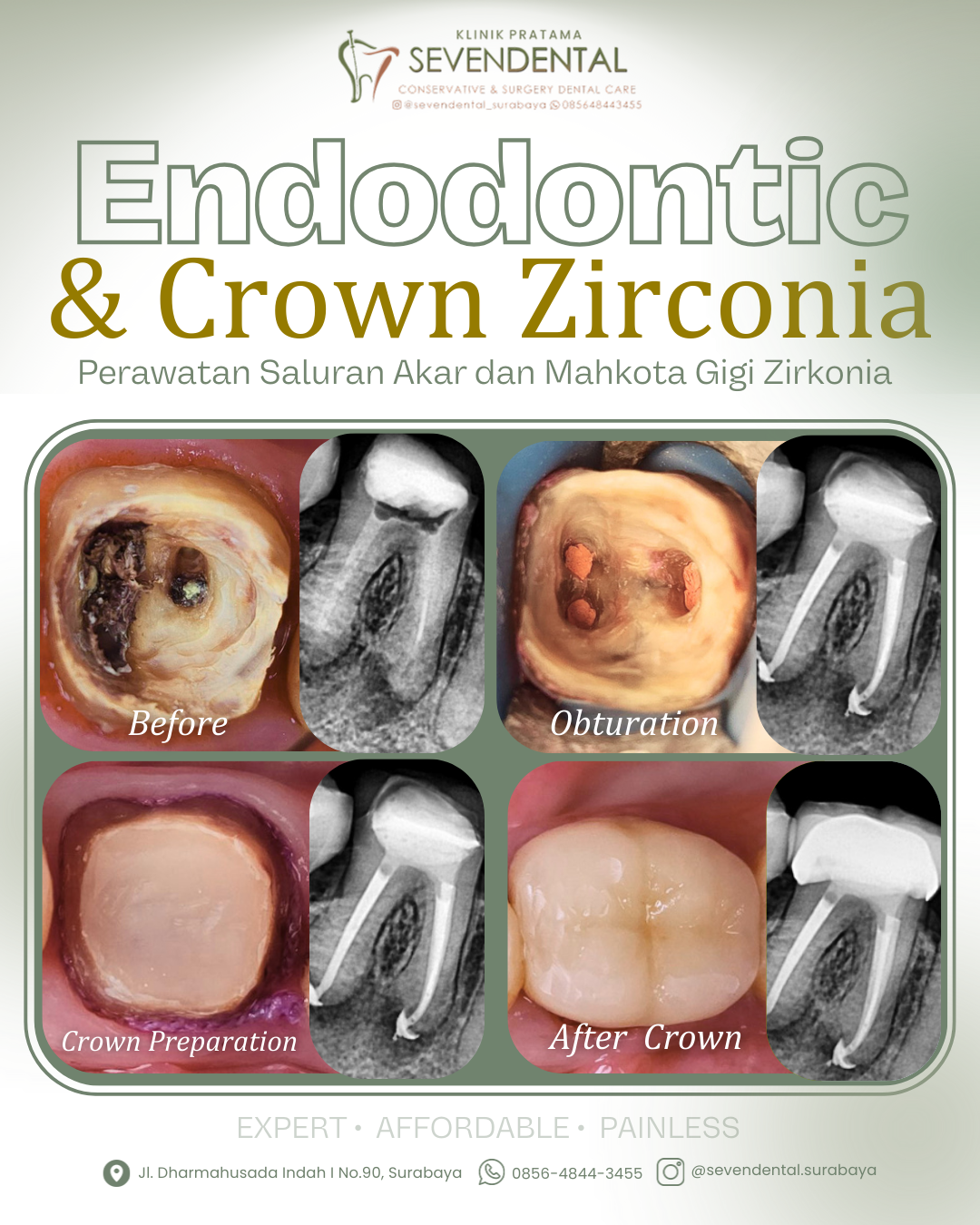 Feed BA Endodontic dan Crown Nn. Ervianti