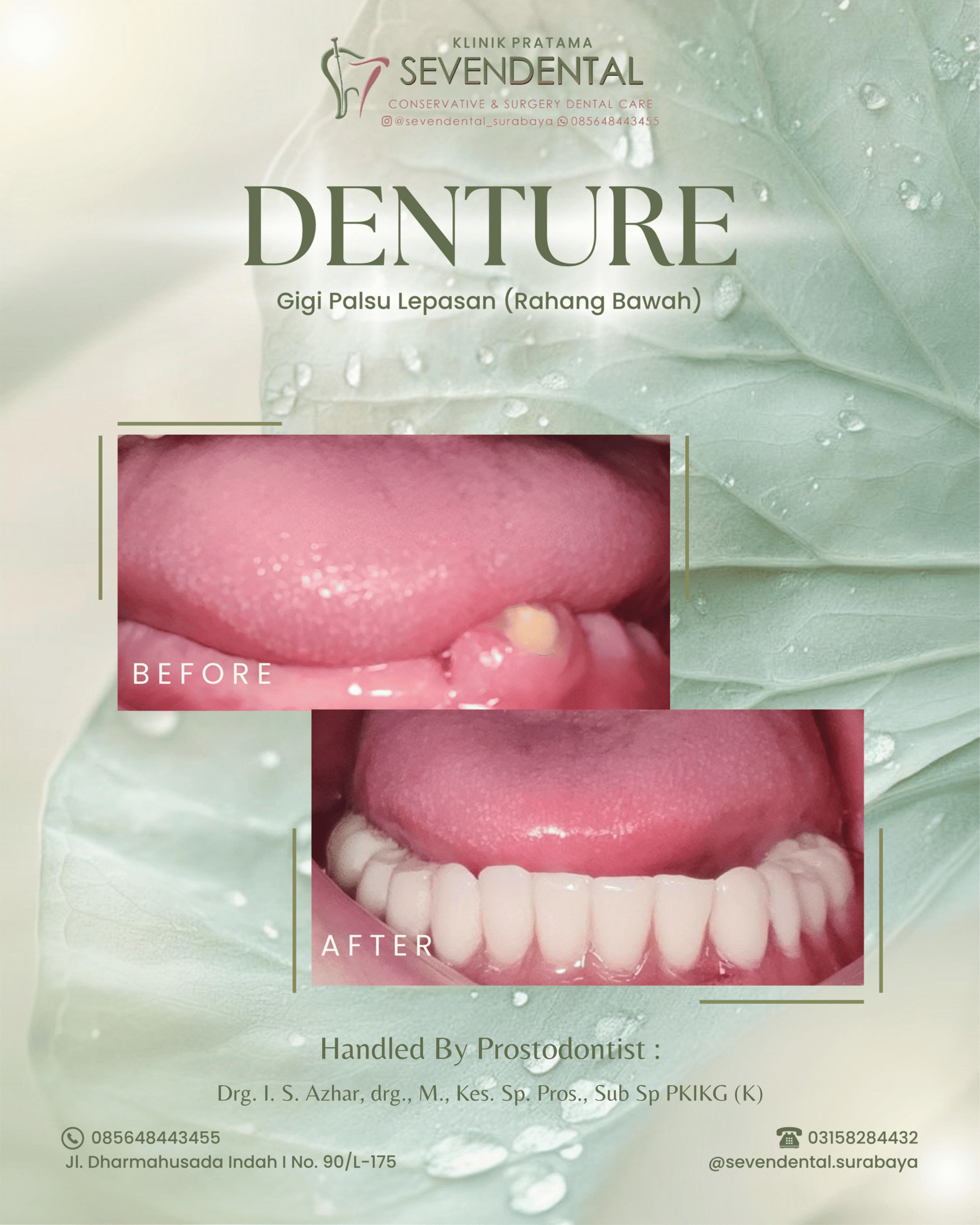 FEED DENTURE BUJUNG